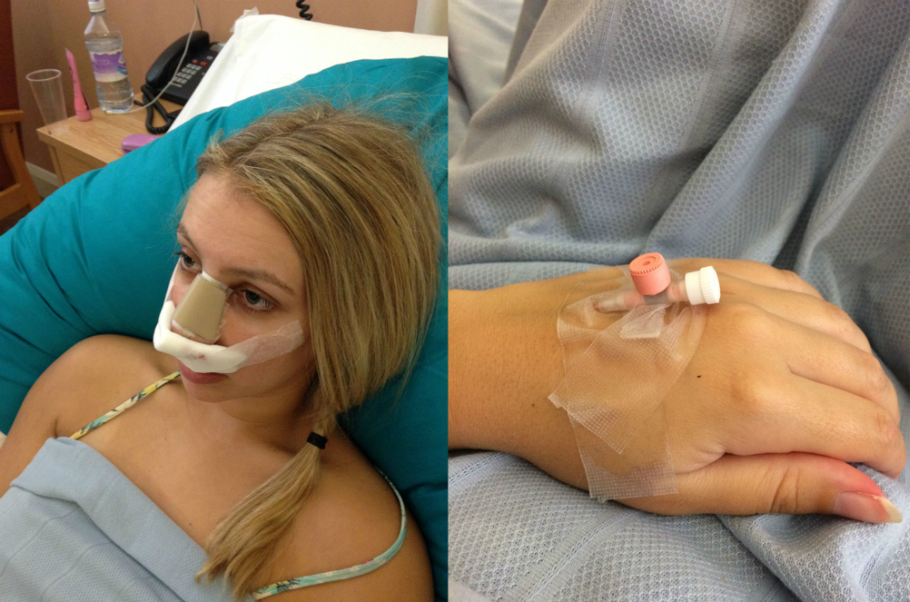 Scarlett Dixon Hospital Rhinoplasty